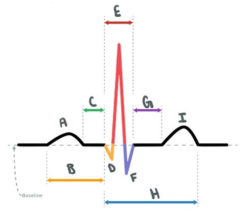 EKG Waves Flashcards Quizlet