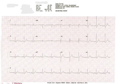 EKG possible left atrial enlargement : r/ReadMyECG - Reddit