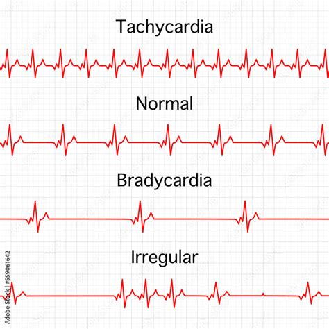 EKG-esimerkkejä