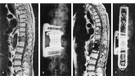 ES2802302A1 - VERTEBRAL PROSTHESIS (Machine-translation by …