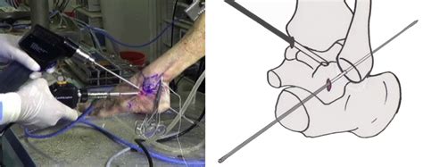 EUA, Ankle Arthroscopy and Lateral Ligament Reconstruction