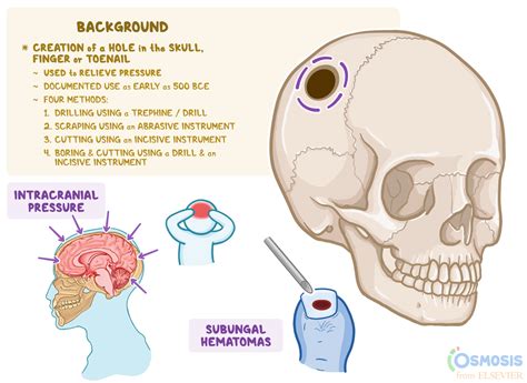 Evolution of the Indications for Trepanation and Trephine in Modern Age - wintechmobiles.com
