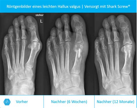 EXPERTE WARNT! ᐅ Hallux Valgus Op RISIKEN …