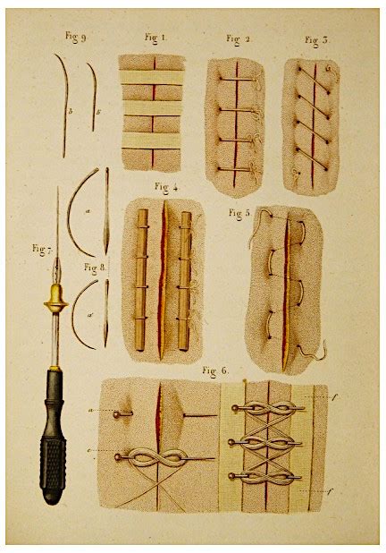Exploring the History of Ancient Surgical Sutures and Threads - wintechmobiles.com