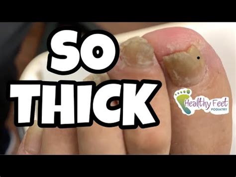 EXTREMELY THICK NAIL CUTTING AND GRINDING OF NAILS, HOW TO ... - YouTube