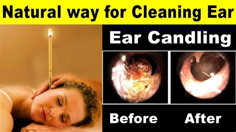 Ear Candling: Is It Just a Ball of Wax? - WNY Urology