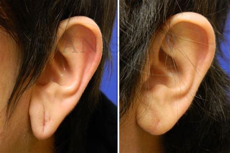 Ear Lobe Repair near Bristol, CT WebMD