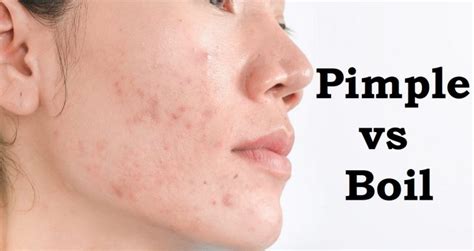 Pimples result from excess oil production and a buildup of dead skin cells, dirt, and bacteria, whereas boils occur when a bacterial infection develops in a hair follicle or area of damaged...