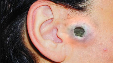 Ear comedone. WARNING: Graphic Content. Viewer discretion is advised.This video show Ear Pinna Comedo Removal from left lower side of face . Old lady presented with open D... 