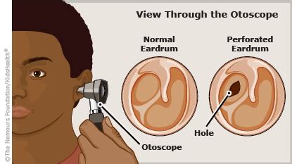 Eardrum Injuries (for Teens) - Nemours Kidshealth