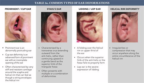 Earlobe Deformities Children