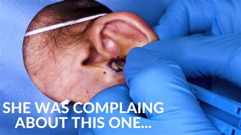 Earlobe cyst removal - YouTube