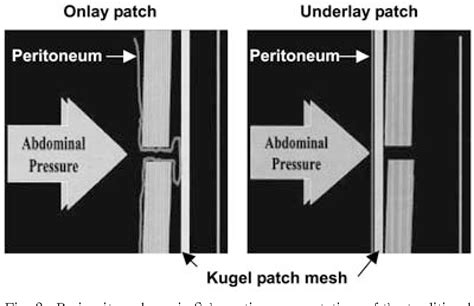 Early Experience of Performing a Modiﬁ ed Kugel Hernia …