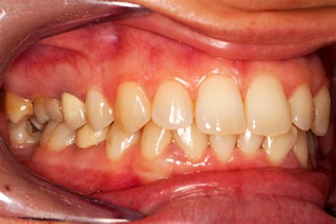 Early Periodontal Disease Triangle Dentistry