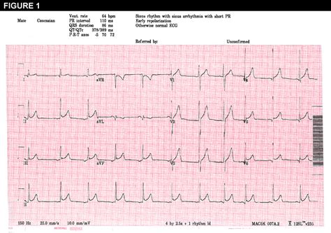 Early Repolarization Pattern on Electrocardiogram—A Benign Finding
