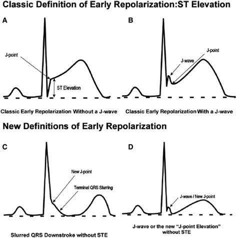 Early Repolarization in Athletes Circulation Arrhythmia and