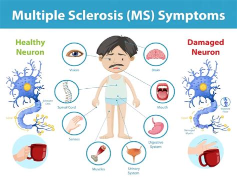 Early Warning Signs of Multiple Sclerosis (MS) - Verywell Health