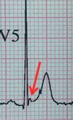 Early repolarization wikidoc