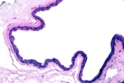 Eccrine Carcinoma Article - StatPearls