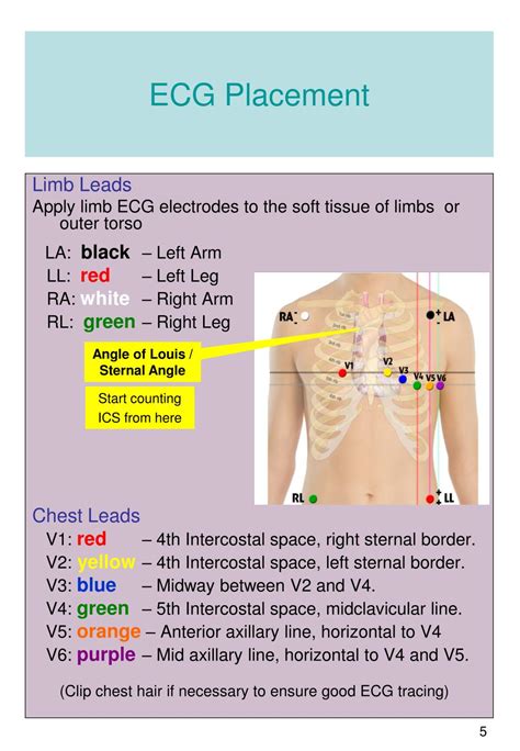 Ecg Replacement Guide Download