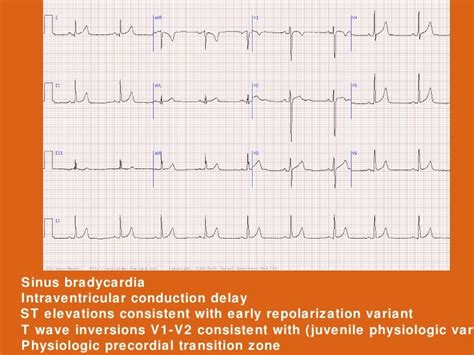 Ecg case - SlideShare