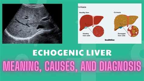 Echogenic lesion in liver meaning. .  ...