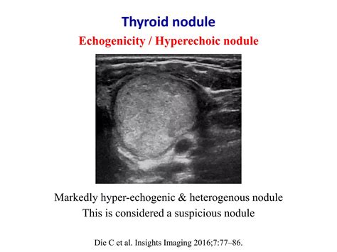 Echogenic thyroid nodule.  The primary goal of thyroid nodule eval It is therefore import...