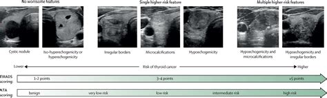 Echogenic thyroid nodule.  Whether these findings Various risk stratification systems show discr...