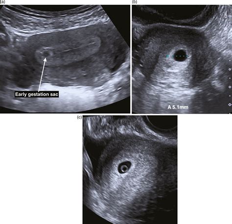 Ectopic Pregnancy - PubMed