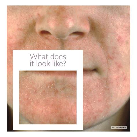 Eczema Flaky Skin On Face - EczemaInfoClub.com