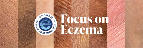 Eczema and Emotional Wellness - National Eczema …