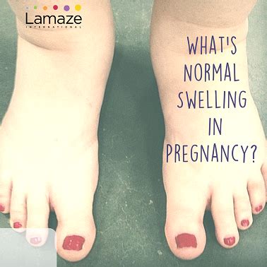 Edema in third trimester