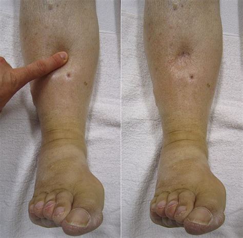 Edema of the Small Intestine - Gluten Free Works: TREATMENT …