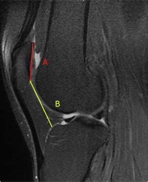 Editorial Commentary: Patellar Tendon-Trochlear Groove Angle …