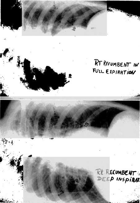 Effect of Lateral Recumbency on Pulmonary Function - Chest