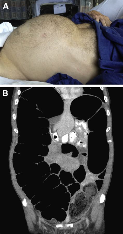 Effect of intravenous Buscopan on colonic distention during