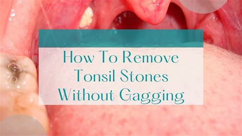 Effective Ways to Remove Tonsil Stones Without Gagging