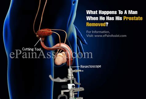 Effects Of Having Prostate Removed - ProstateProHelp.com