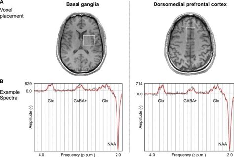 Effects of cannabidiol on brain excitation and inhibition systems; a randomised placebo-controlled single dose trial during magnetic resonance spectroscopy in adul…