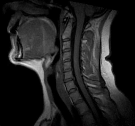 Ein fall von compressions myelitis infolge eines myxo sarkoms der wirbelsäure. - Remplacement de courroie d'entraînement de tondeuse husqvarna awd.
