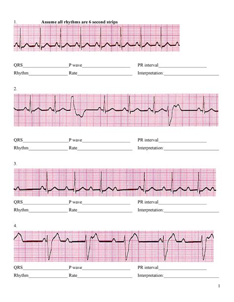Full Transcript: EKG Interpretation, part 3: Analysis of Heart Rhythm, Heart Rate, P wave, PR interval and QRS complex. Learn the key steps in analyzing an EKG strip: determining the heart rhythm (regular vs. irregular), P waves; PR intervals, QRS complexes & more!. 