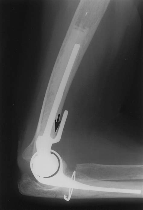 Elbow Arthroplasty - an overview ScienceDirect Topics