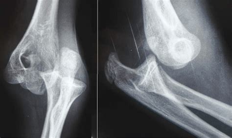 Elbow Dislocation Concise Medical Knowledge