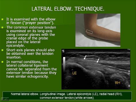 Elbow ultrasound: technique and ultrasound anatomy