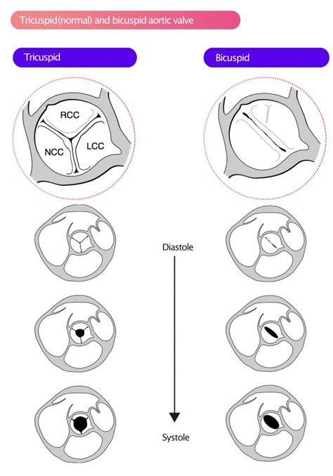 Electrocardiogram screening for aortic valve stenosis using …