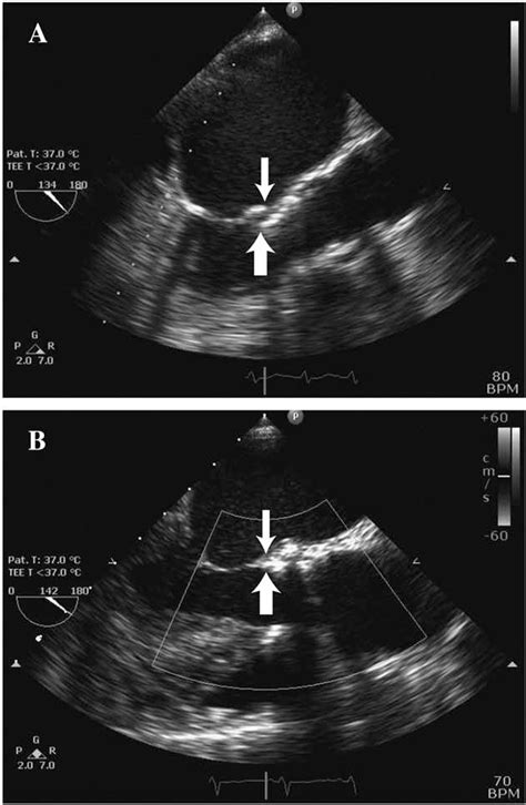 Electrocardiographic changes and clinical outcomes after …