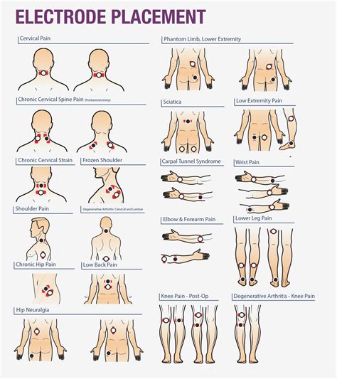 Electrode placement for electrical stimulation chart.  Examples of electrodes are the...