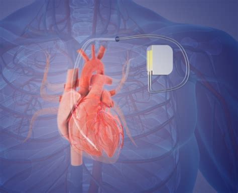 Electrophysiology Treatments Pacemaker Port Huron, MI