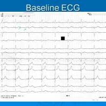 Electrophysiology of atropine - PubMed