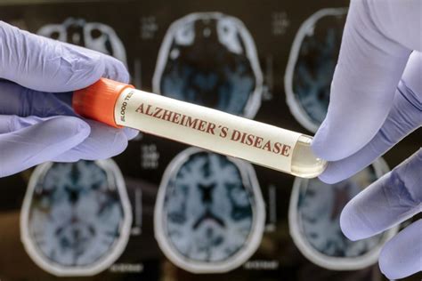 July 17 (Reuters) - An experimental drug from Eli Lilly works best if Alzheimer's patients are treated as early as possible, ideally before they develop symptoms of the brain-wasting disease .... 